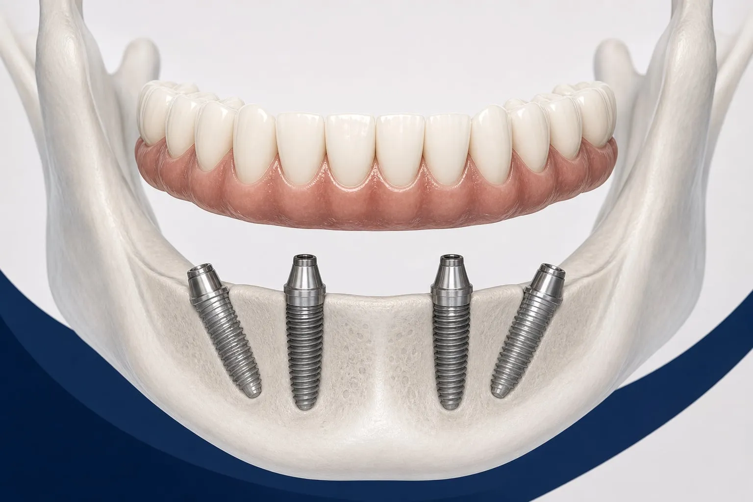 A 3D illustration of four implants placed at strategic angles