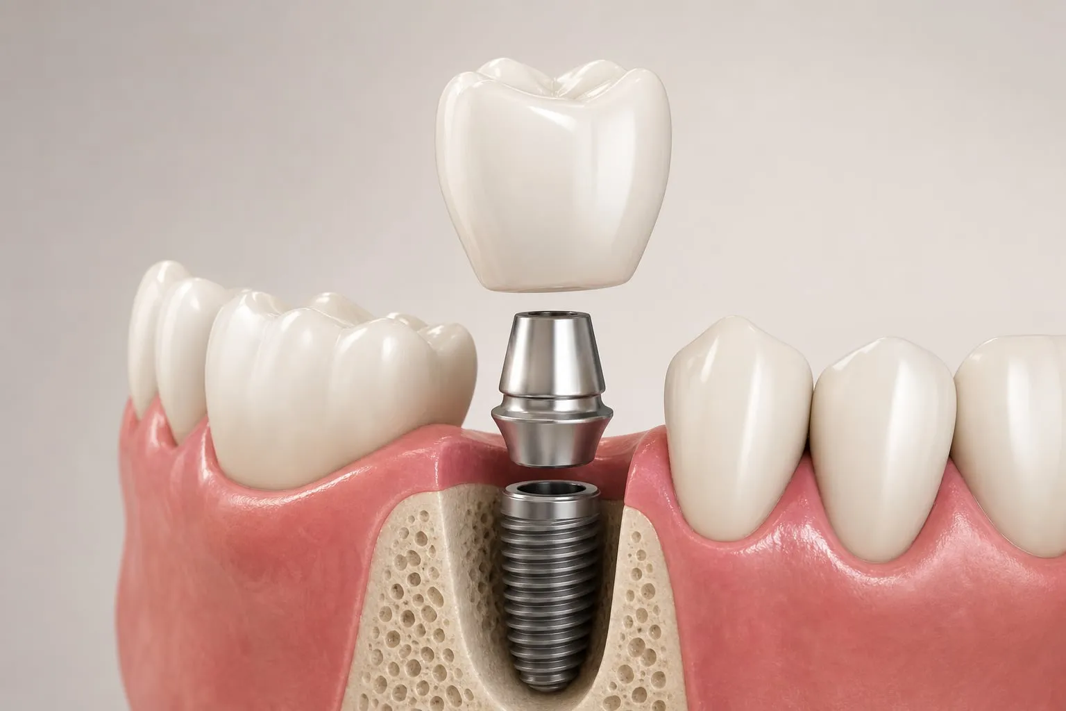 A 3D illustration of a dental implant crown and abutment